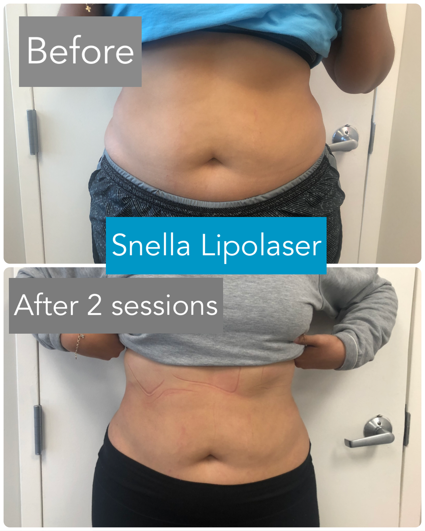 Snella Body Contouring Lipolaser